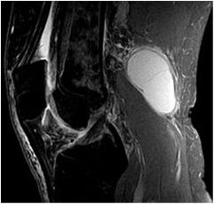 Treatment of Meniscal Injuries Treatment depends on type, size, and location of the injury within meniscus Outer 1/3 has better vascular supply and may heal on its own Inner 2/3 has poor blood supply