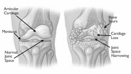 Knee Pain Common causes of knee pain include the following: OA of the knee Chondromalacia patella Ligamentous injuries Meniscal injuries Patellar tendinitis Patellofemoral syndrome Iliotibial band