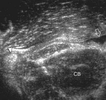 Sonographic Findings of Pectoralis Major Tears ity from the remaining muscle head excluded a full-thickness tear of the pectoralis major