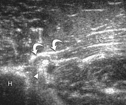 Sonography longitudinal to the pectoralis major sternal head at the musculotendinous junction (A) and distal (B) with corresponding axial