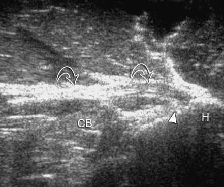 expected site of the distal tendon. Sonography longitudinal to the clavicular head (D) shows intact fibers (filled curved arrows).