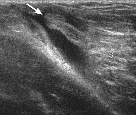 Weaver et al the medial two thirds of the clavicle; these fibers insert distally and anteriorly.