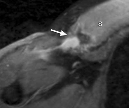 superior to the clavicular head. 4 In total, the cephalocaudad dimension of the distal tendon insertion on the humerus is approximately 4 to 6 cm.