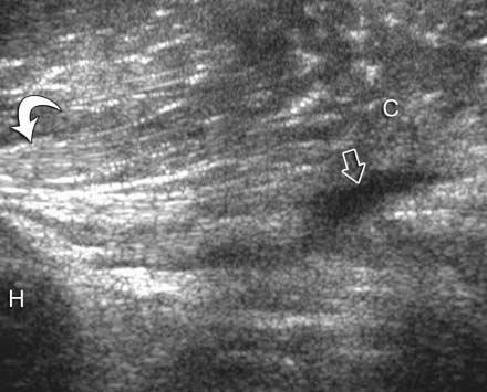 5 cm inferior to the quadrilateral space and 5 to 10 mm superior to the lateral head of the triceps tendon, whereas the inferior extent of the tendon is typically superior to the deltoid attachment.