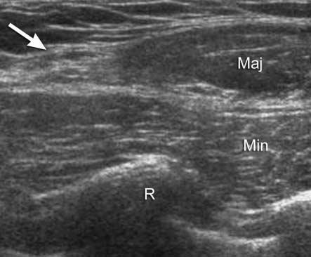 Sonographic Findings of Pectoralis Major Tears Figure 5. Full-thickness tear of the sternal and clavicular heads (full-thickness pectoralis major tear).