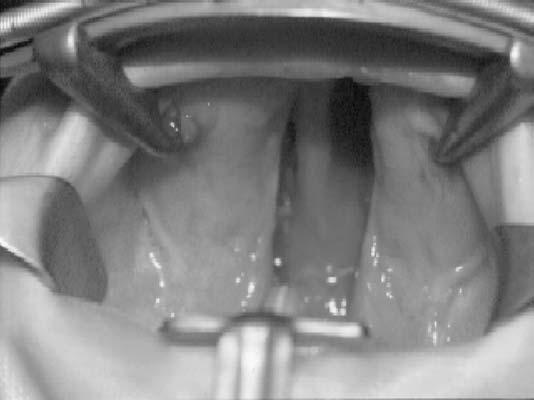 238 A.M. Sadove et al / Clin Plastic Surg 31 (2004) 231 241 clefts of the palate, a third variation of mucoperiosteal flap technique, the two-flap palatoplasty, is used.
