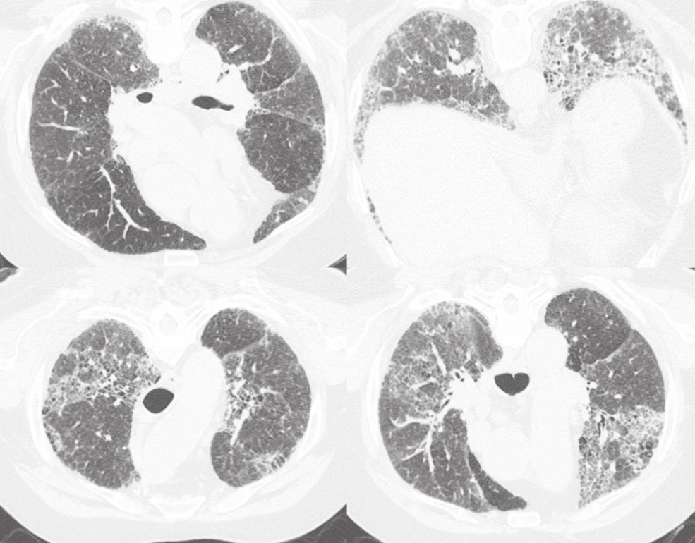 Significance of granulomatous inflammation in usual interstitial pneumonia 161 Fig. 1. High Resolution chest CT for case 1.
