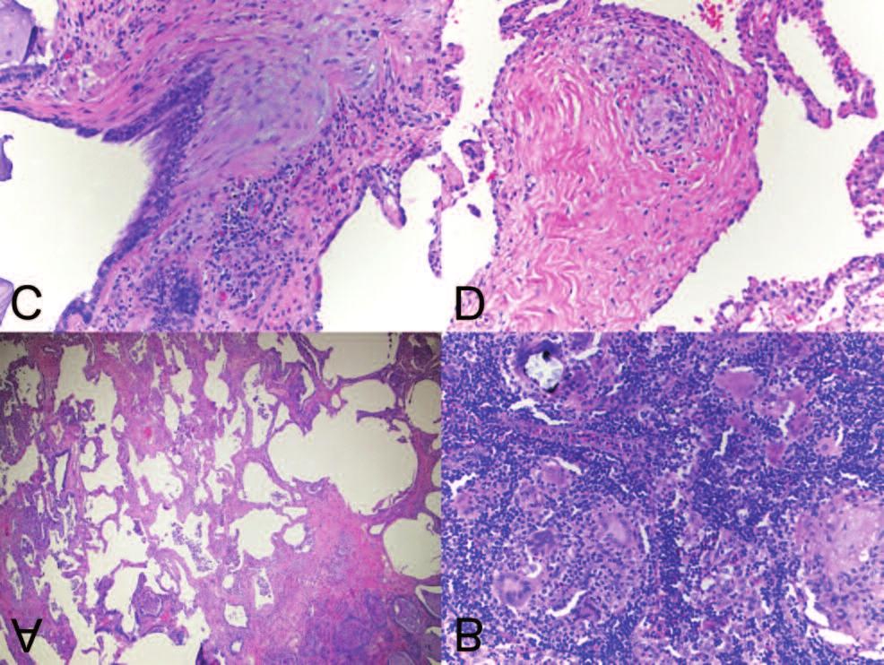 162 R. Tomic, H.J. Kim, M. Bors, et al. Fig. 2. Histopathology for case 1(all H&E). Low power view of active fibrosis adjacent to areas of honeycombing (A).