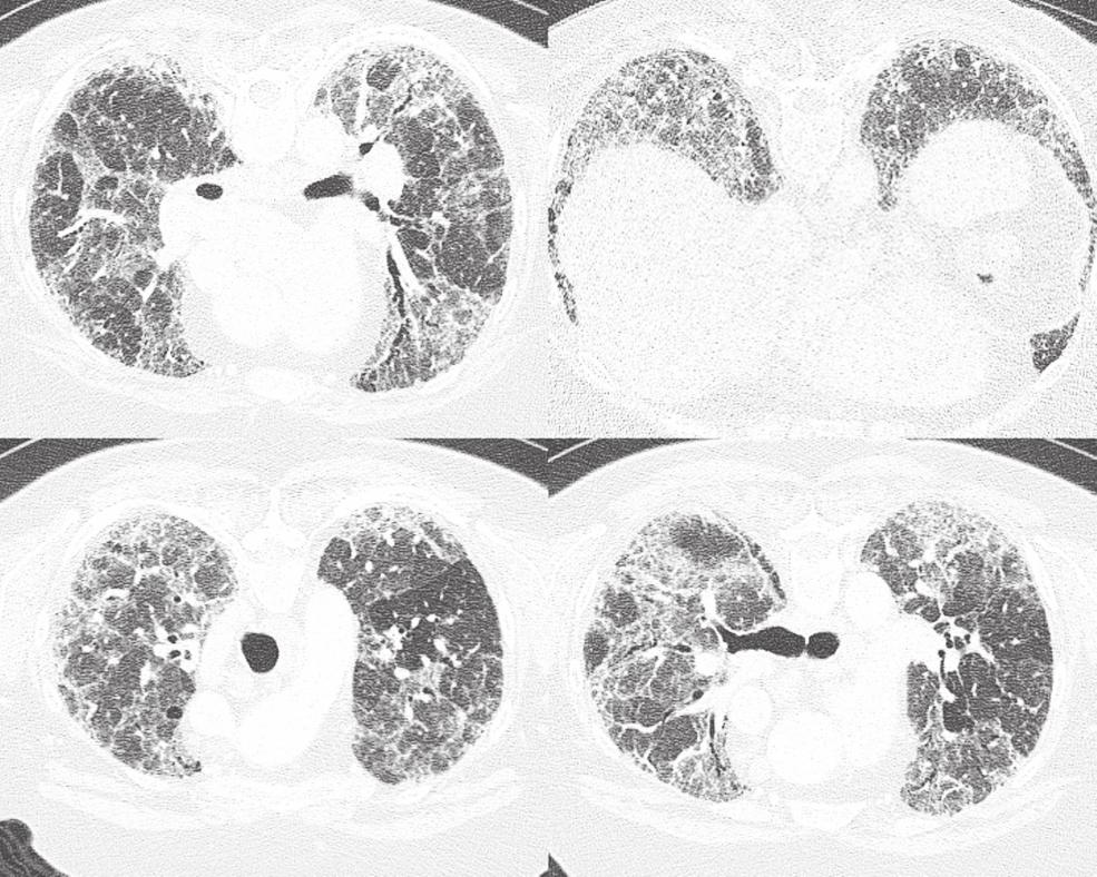 Significance of granulomatous inflammation in usual interstitial pneumonia 163 Fig. 3. High Resolution chest CT for case 2.
