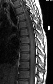 Thoracic Spine: Normal Anatomy on MRI Spinal cord Vertebral body Ligamentum flavum Intervertebral disc Spinous