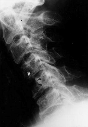 Companion Patient 1: Lateral C-Spine Spinal infection. Early radiographic abnormalities. Lateral radiograph of the cervical spine.