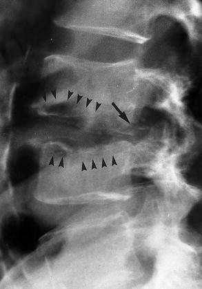 Companion Patient 2: Lateral L- Spine Vertebral infection. Advanced radiographic changes. Lateral radiograph of the lumbar spine.