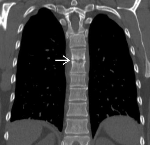Companion Patient 3: Infectious Spondylodiscitis on CT Disc space narrowing with erosion of the adjacent vertebral