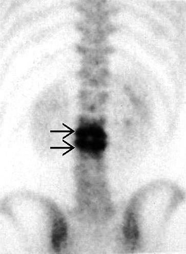 Companion Patient 5. Bone Scan: three-phase technetium-99m.