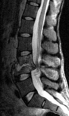 Companion Patient 6. MRI: diskitis/osteomyelitis Destruction of L3-4 disk space with the adjacent endplate and vertebral body.