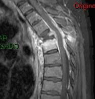 Our Patient MRI: Spondylodiscitis Severe compression of T4 with abnormal enhancement Soft tissue enhancement * Abnormal