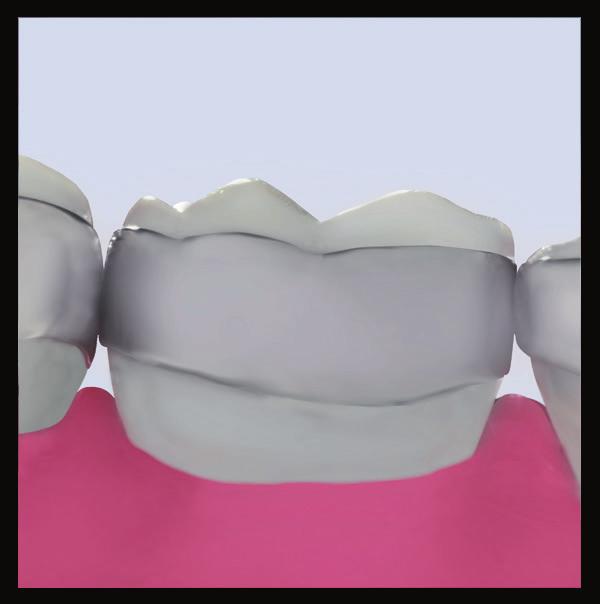 and gingival interferences Micro-etched inner