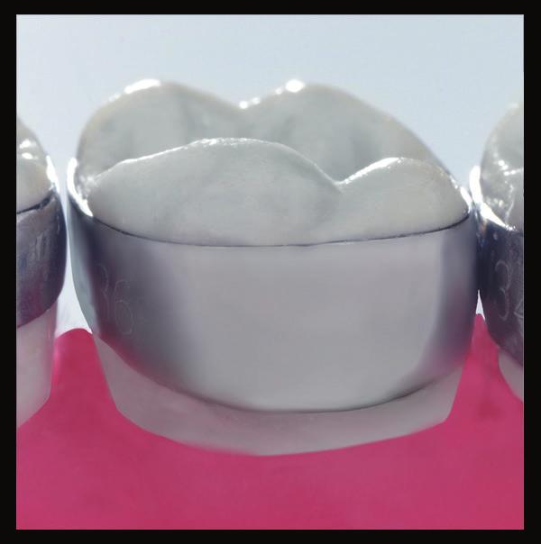 walls for reduced separation Increased occlusal