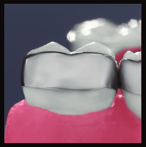 occlusal and gingival interferences Micro-etched