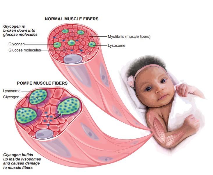 What are the different forms of Pompe disease? Infantile-onset Pompe disease (IOPD) This form of Pompe disease begins within the first few months of life.