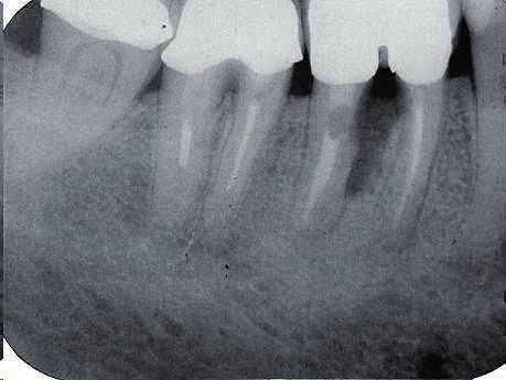 MT CEMENTS - Clinical Pictures The radiographs show a tooth with a perforated root canal.