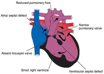 Single ventricle lesions
