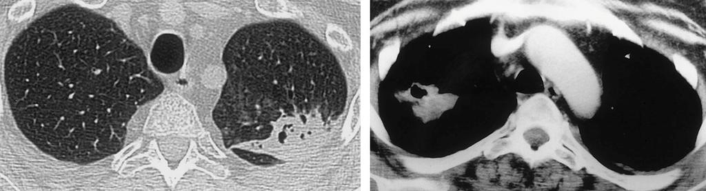 Mycobacterial and Nocardial Mycobacterial Infection: Consolidation and cavitation of left apex.