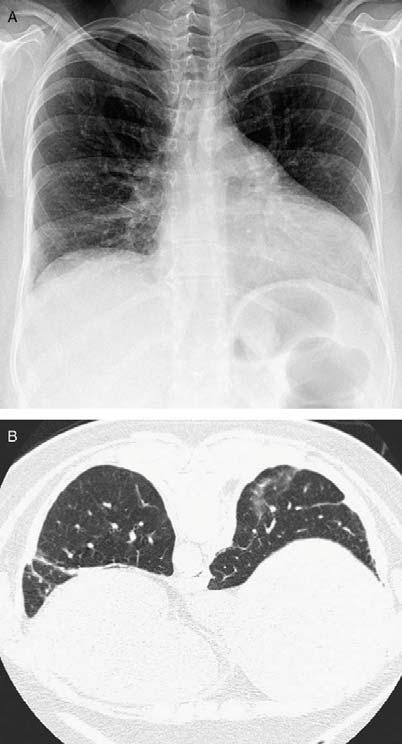 Shrinking lung syndrome: Images Elevated hemidiaphragms, small lung volumes, and bibasilar atelectasis