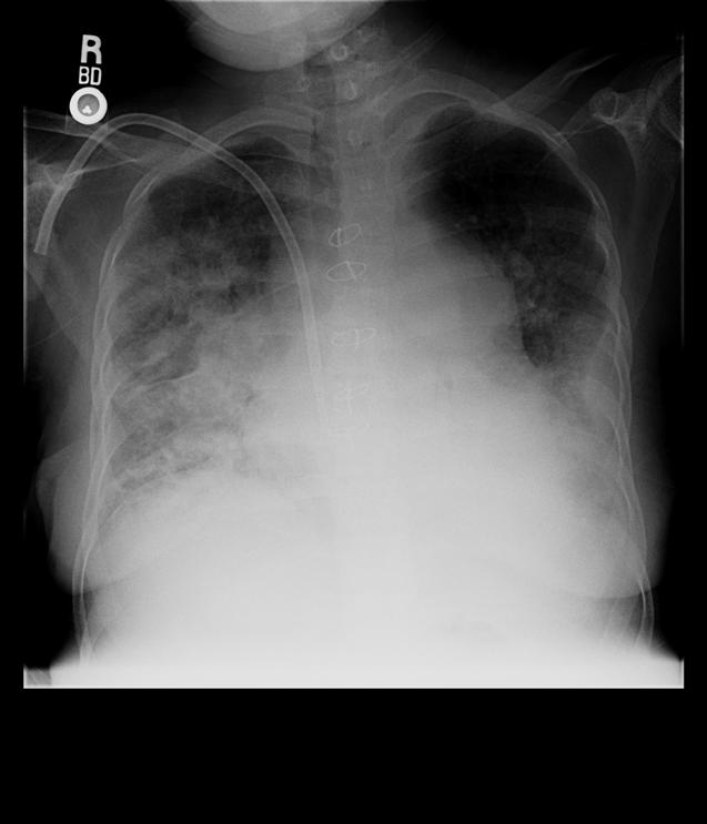 Chest X Ray Findings concerning for multifocal pneumonia though a component of vascular