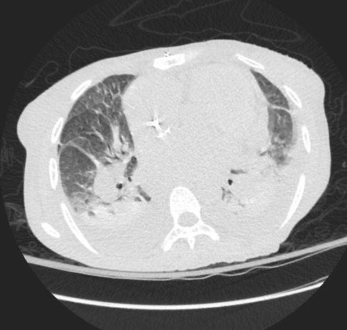 Chest CT: Effusions, atelectasis Bilateral moderate sized pleural effusions worsen since three months ago.
