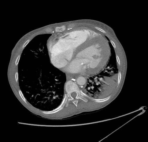 Chest CT: Cardiomegaly Cardiomegaly with