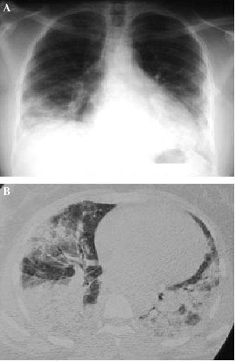 Acute lupus pneumonitis Lung parenchyma involvement can be acute or chronic. Acute lupus pneumonitis: Non specific, may simulate infection, pulmonary embolism or other.