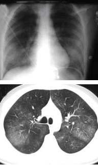 Acute pulmonary hemorrhage Acute pulmonary hemorrhage: Bilateral lung infiltrates, ranging from limited ground glass opacities to dense