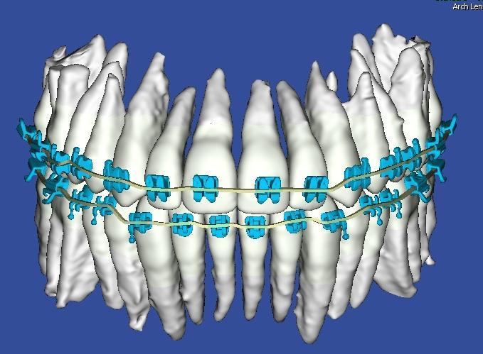 Based on the position of the bracket slot on each individual tooth, the SureSmile software calculates the archwire bends necessary to move the patient s teeth to the final position dictated by the