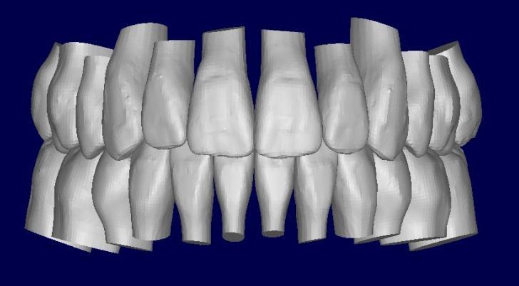 Final models were digitized as stereolithography (.stl) files using a 3Shape R700 model scanner and ScanIt Orthodontics software (3Shape A/S, Copenhagen Denmark).
