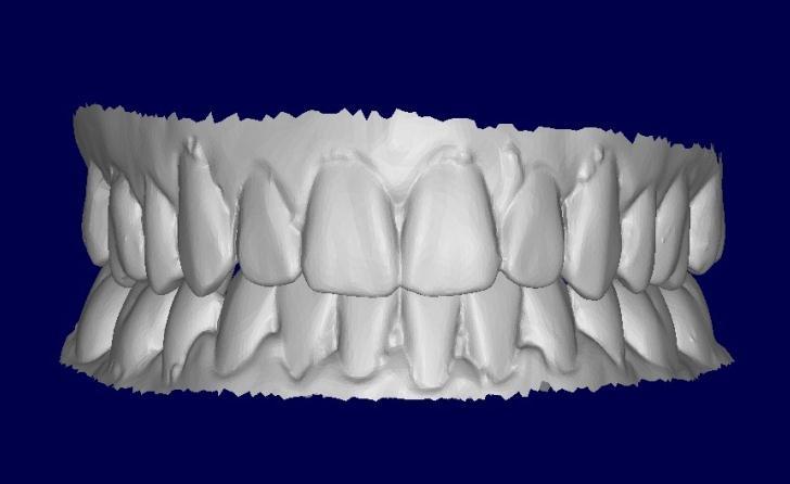 SureSmile plan models were exported segmented as individual teeth.