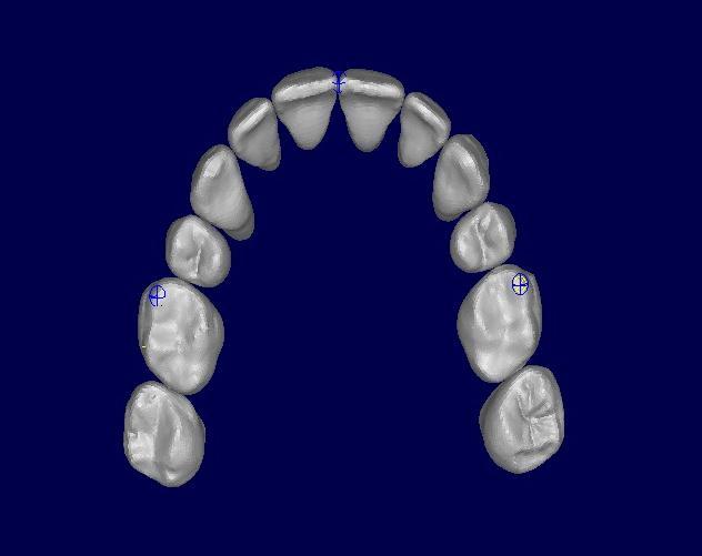 Arch Registration The final model for each individual arch was superimposed on the SureSmile plan model utilizing best fit surface based registration.