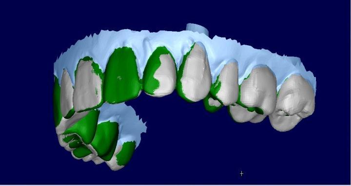 Tooth Position Analysis To ensure that tooth position analysis was based solely on tooth surface features,