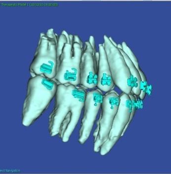 Data obtained from cone beam CT imaging or SureSmile s intra-oral optical scanner, the OraScanner, is used to construct a 3D