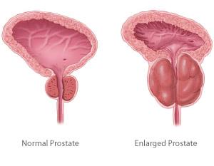 HOLEP (HOLMIUM LASER ENUCLEATION OF PROSTATE ) What does the procedure involve? Removal of obstructing prostate tissue using a telescope and a laser. What are the alternatives to this procedure?