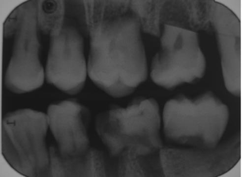 , Rochester, NY) b Figure 2 a Extraoral bitewing images taken with Planmeca Promax Digital Panoramic X-ray unit