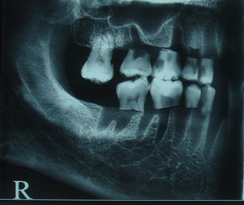 Observers were a doctorate student and two dentomaxillofacial radiologists with 10 and 15 years experience.