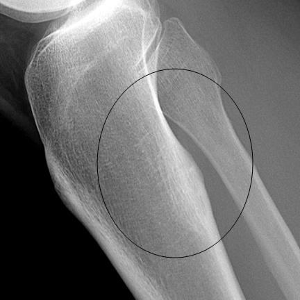 Follow Up X-ray: 2 Months Later Anterior No soft tissue masses No bone lesions Posterior Focally sclerotic, slightly