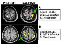 Constraint-Induced Motor Therapy Functional MRI - Pre- and