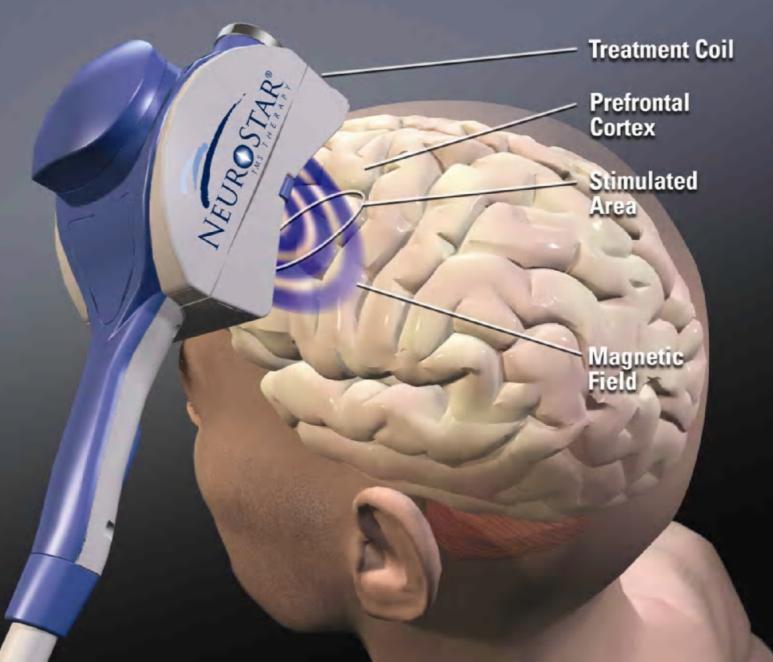Transcranial Magnetic Stimulation (TMS) The treatment coil produces MRI-strength magnetic field pulses. Magnetic field pulses pass unimpeded through the cranium for 2-3 cm.