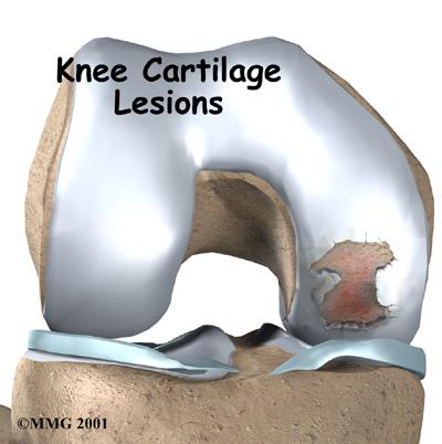 Introduction Articular cartilage problems in the knee joint are common. Injured areas, called lesions, often show up as tears or pot holes in the surface of the cartilage.