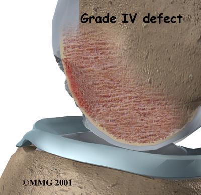 A grade IV lesion goes completely through all layers of the cartilage. It is diagnosed as a fullthickness lesion. Sometimes part of the torn cartilage will break off inside the joint.