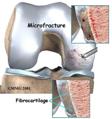 articular cartilage, it does not function as well for weight bearing as articular cartilage. The fibrocartilage that forms may not be strong enough to remove all the symptoms of pain in the knee.