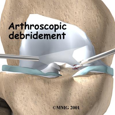 Microfracture Abrasion Arthroplasty When osteoarthritis affects a joint, the articular cartilage can wear away, leaving bone rubbing on bone. This causes the bone to become hard and polished.