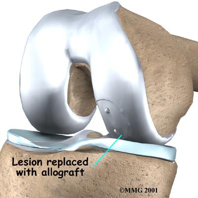 much like using donor hearts, kidneys, and other organs. The osteochondral allograft procedure is mostly used for OCD after other surgeries have failed.